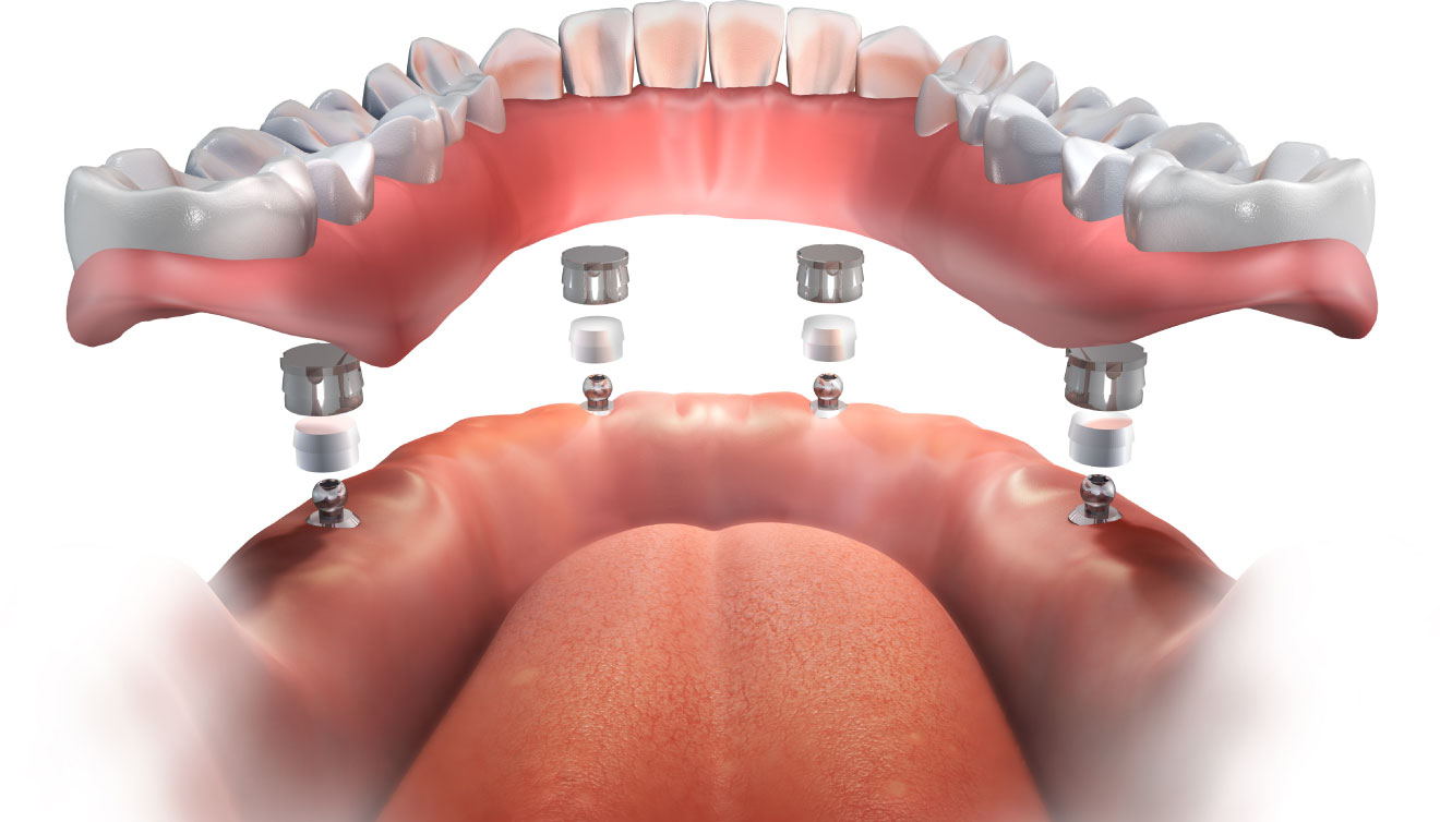 Bir Günde İmplant Üstü Protez