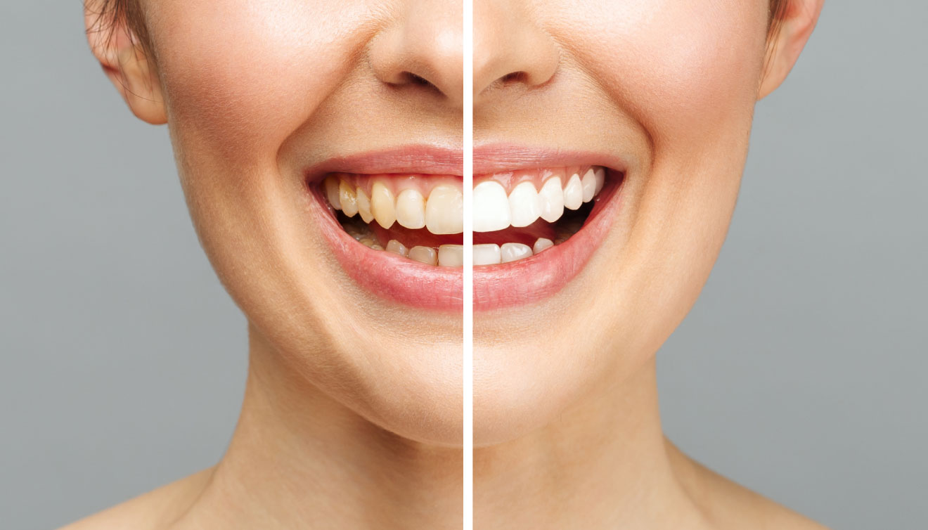 Bleaching Diş Beyazlatma