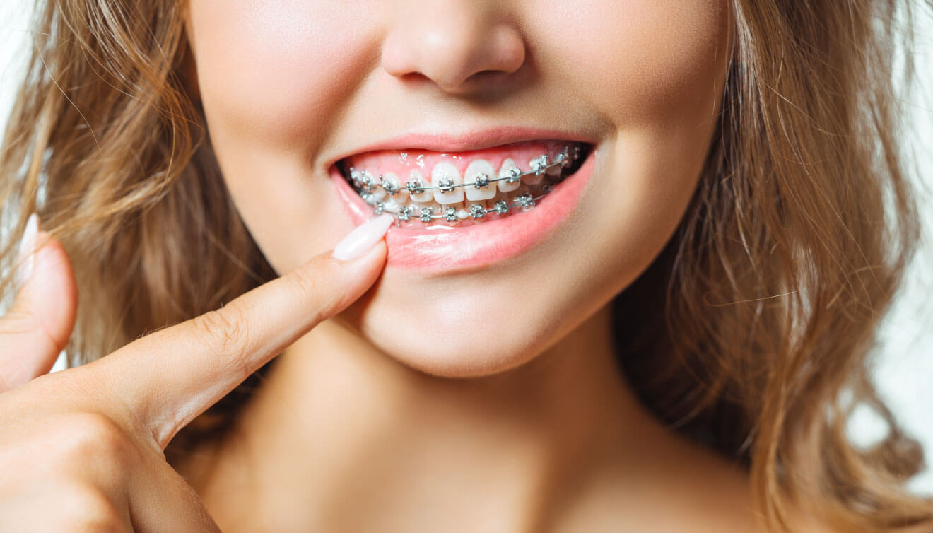 Ortodonti (Diş Teli)